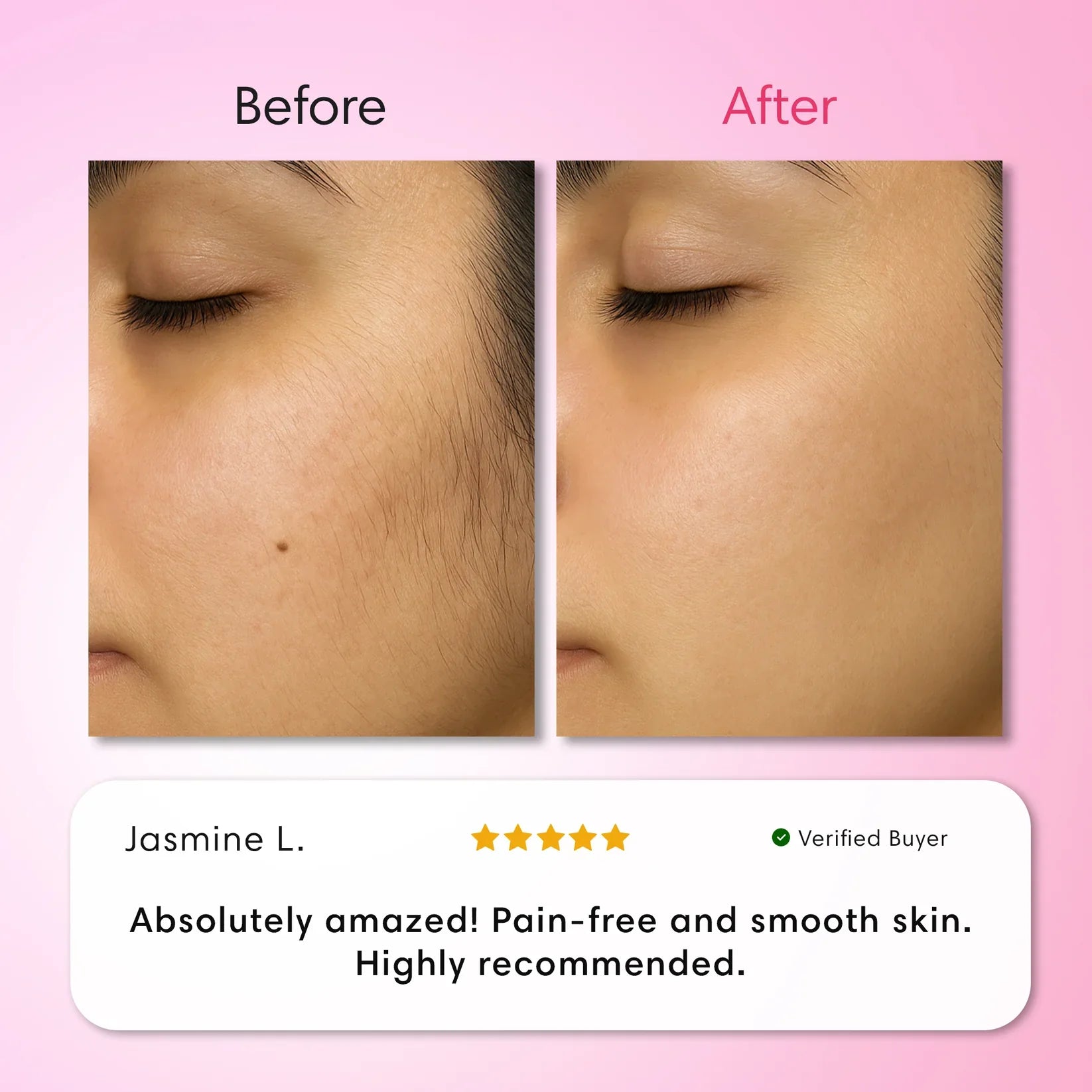Cyperus™ Hair Removal Kit