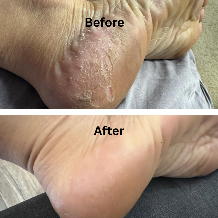 SwissCure Duo – Callus Remover & Urea Cream for Soft, Smooth Feet!